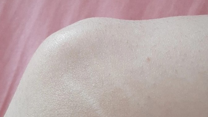 Bacaklarının her açısında böyle çatlaklar var, nasıl geçer bunlar?