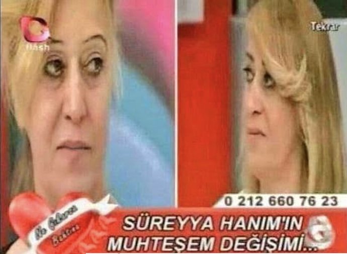 Mika estetik operasyon geçirmiş, başka birine dönüşmüş resmen. Ne düşünüyorsunuz?