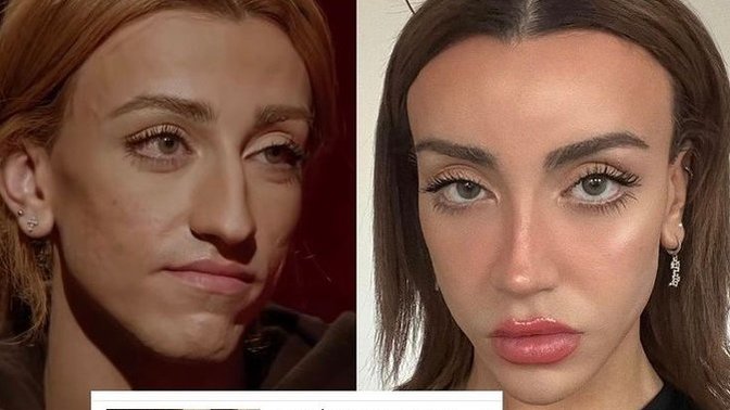 Mika estetik operasyon geçirmiş, başka birine dönüşmüş resmen. Ne düşünüyorsunuz?