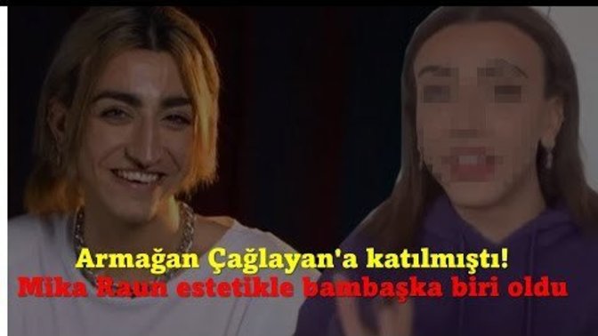 Mika Raun Estetikle Bambaşka Biri Oldu. Erkeklerin estetik ameliyat yaptırmalarını nasıl karşılıyorsun?