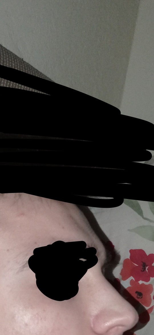 Bu burna nasıl estetik olur? Fotoğraflı?