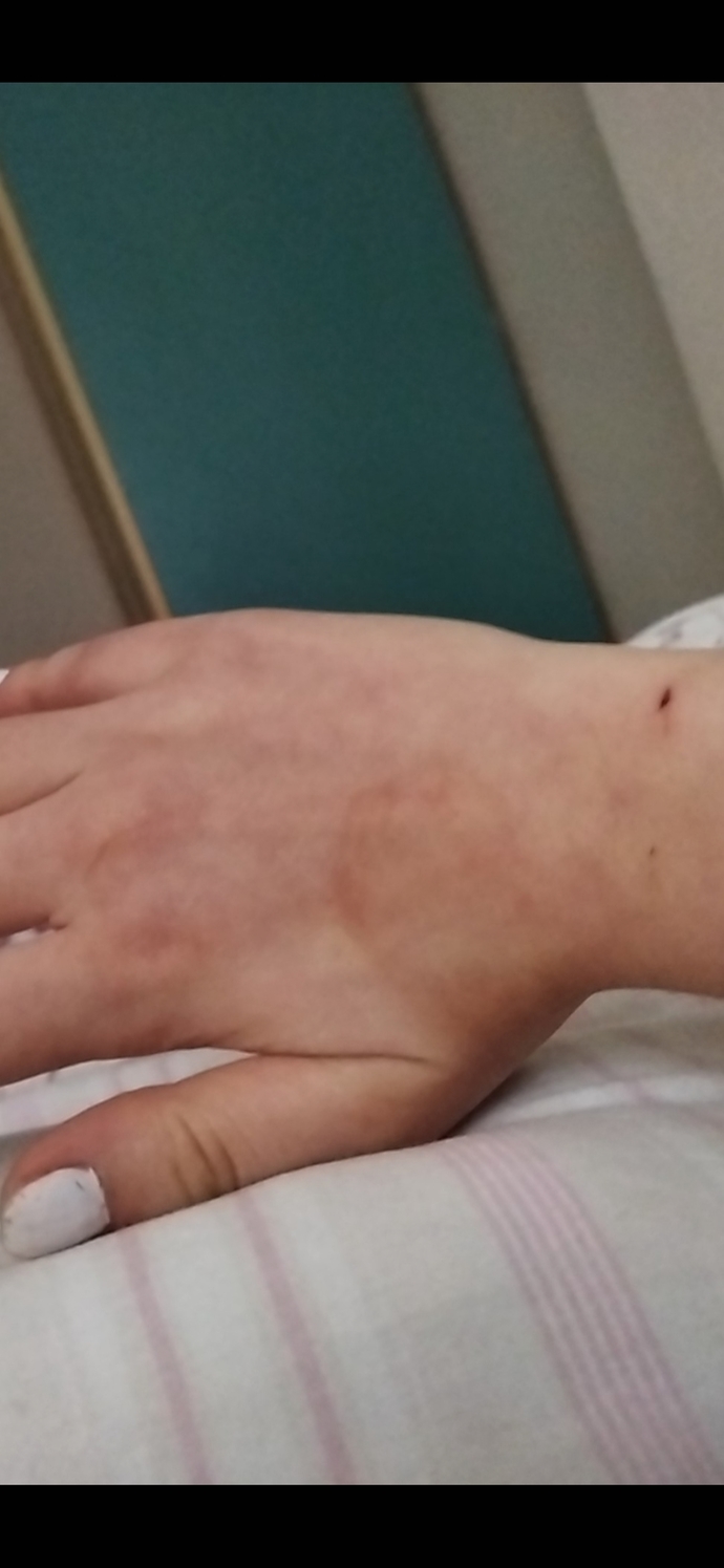 Gluten alerjisi?