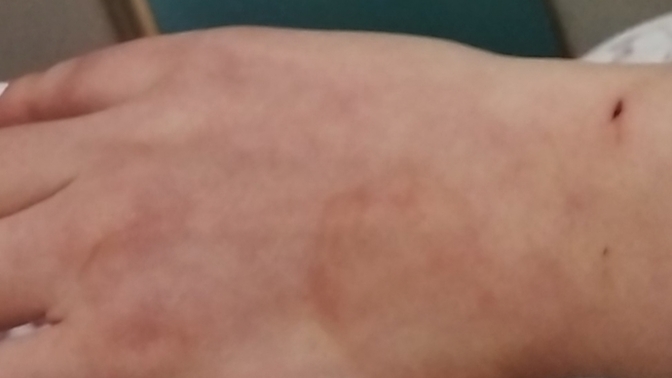 Gluten alerjisi?