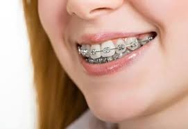 Oral sekste diş telleri tehlikeli midir? Diş teli kullanan birinin oral yapması sizi tedirgin eder mi?