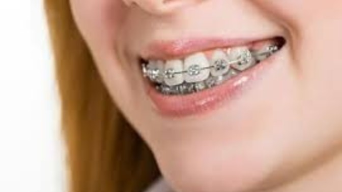 Oral sekste diş telleri tehlikeli midir? Diş teli kullanan birinin oral yapması sizi tedirgin eder mi?