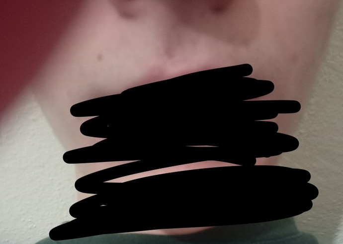 Dudağımın üstündeki dikiş izi nasıl geçer, ssli?