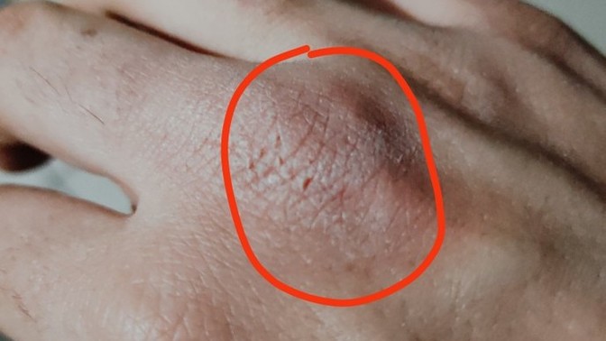 Elde kaşıntı neden olur, nasıl geçer?