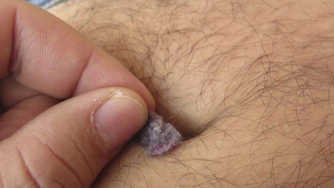 Göbek deliğinden pamukçuk çıkan biriyle sevgili olur musun?