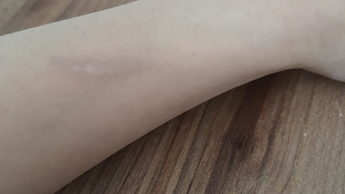 Kaynayan Süt tenceresine kolum çarptı yandı neler yapabilirim?