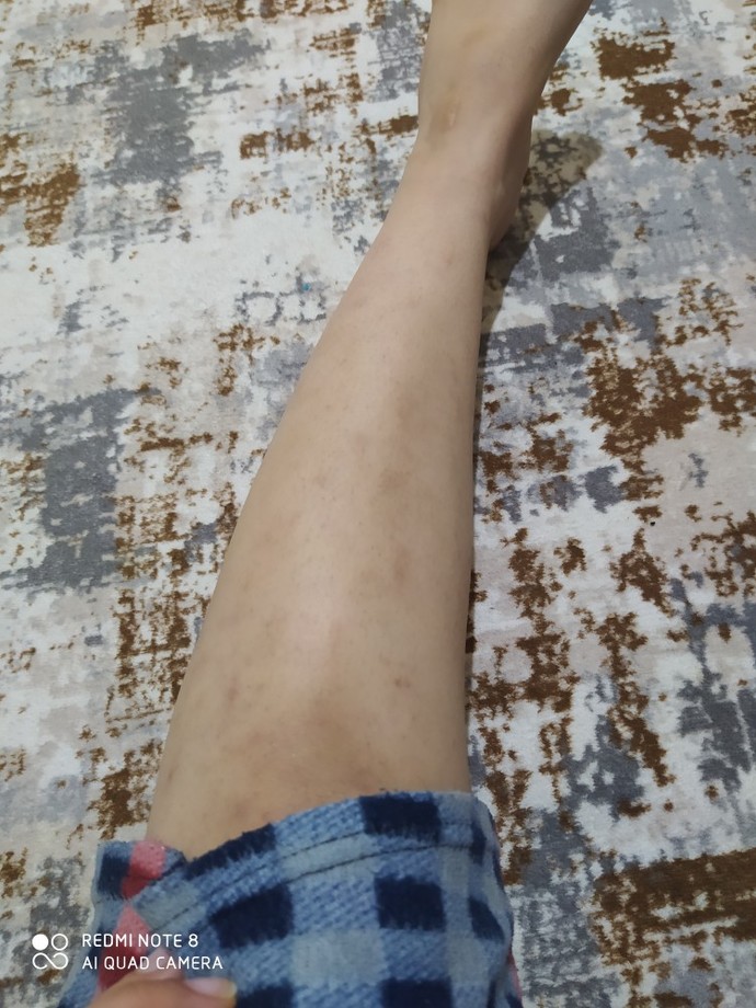 Bacağımdaki yanık izi derinmi acaba?