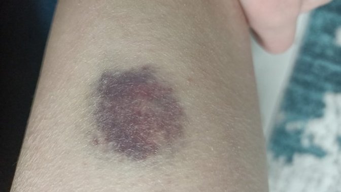 Aşk büyüsü yaptırdım, bacağımda sebepsiz koyu bir morluk oluştu. Neden olabilir?