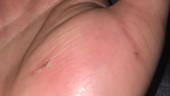 Kedi ısırığından sonra oluşan şişme ve ağrıya ne iyi gelir?