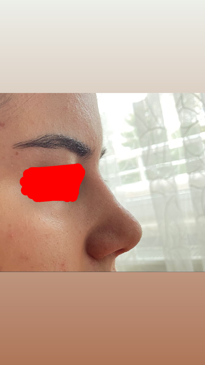 Burnumu yaptırdım sizce şekli güzel olmuş mu?