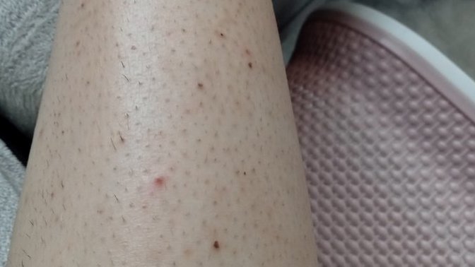 Bacaklarıma fondöten sürsem düzelir mi?