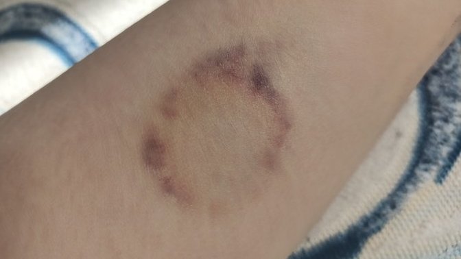 Aşk büyüsü yaptırdım ve böyle bir leke oluştu. Nedendir?
