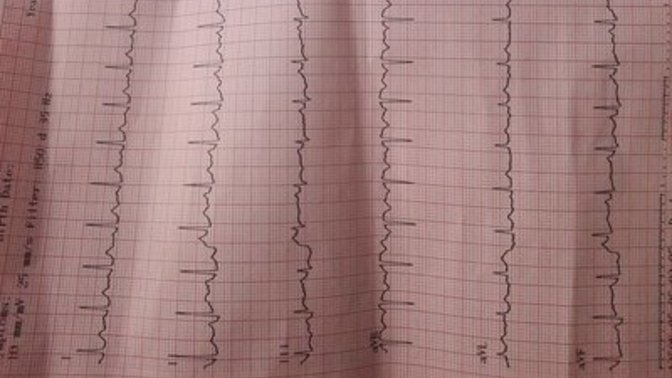 BENDE RİTİM BOZUKLUGU MU VAR CİDDEN?