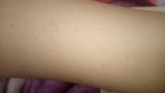 10 seanslık lazer epilasyon aldım. 4 seanstan iki hafta sonra tüyler bu şekilde normal mi?