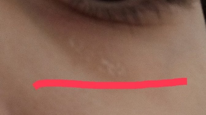 Cildim bu hale geldi. Nemlendirici kullanmama rağmen böyle pul pul dökülüyor 😖 Ne yapsam düzelir?