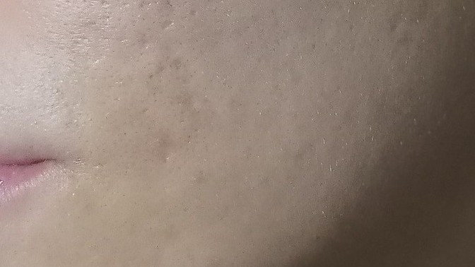 Bu sivilce cukurlarinin geçmesi imkansizmi?