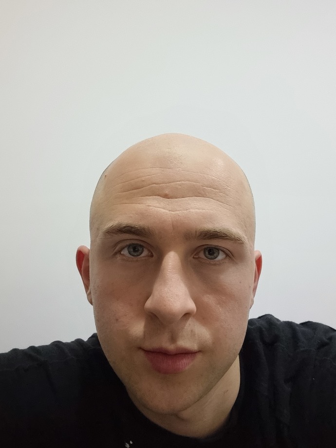 Sizce saç ektirmeli miyim?