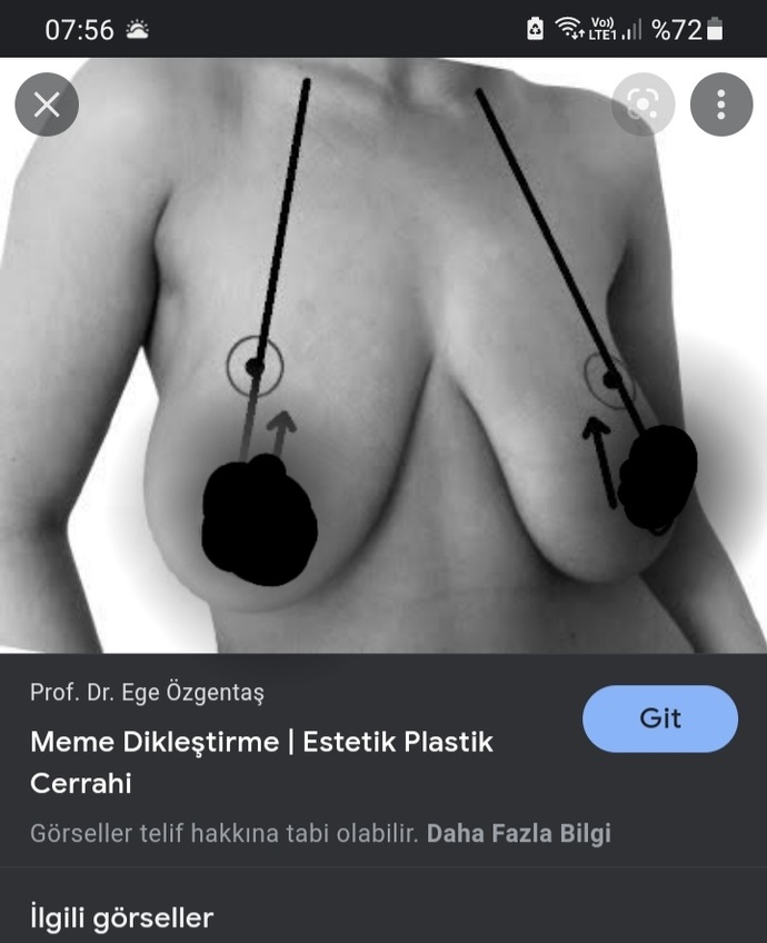 Sarkık göğüs, spor ve diyetle dikleşebilir mi?