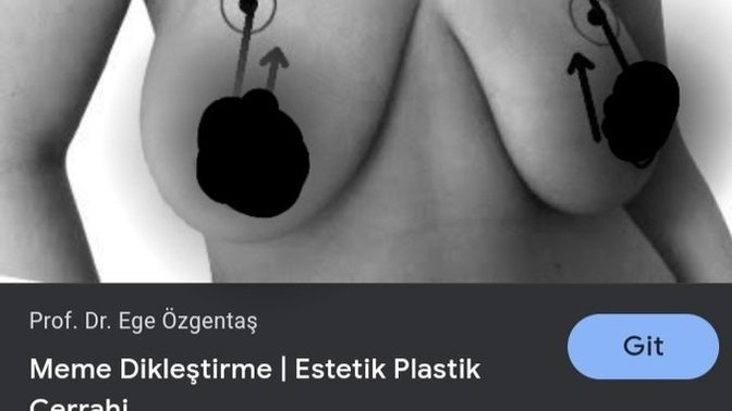Sarkık göğüs, spor ve diyetle dikleşebilir mi?