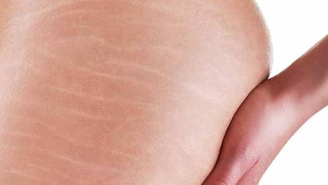 Vücut çatlakları çekicilik mi katar itici mi gelir?