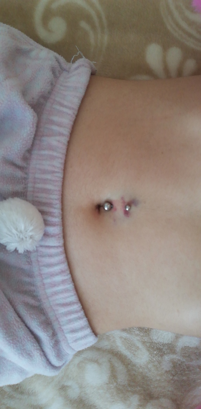 Piercing yaptırdığım akşamında bu şekilde morarma olması normal mi? ?