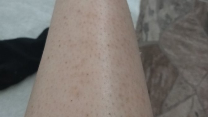 Bacaktaki lekeler nasıl gider fotolu?