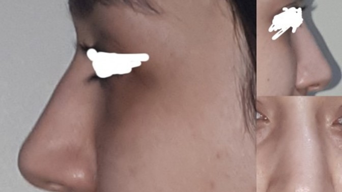 Burnum yamuk, maskesiz dışarı çıkamıyorum. Ne yapacağım?
