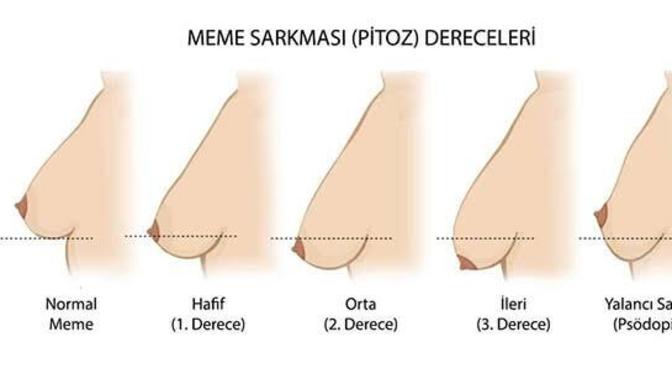 Memelerim hafif sarkık yapıda ve küçük. Bu estetiksiz düzeltilmez mi?