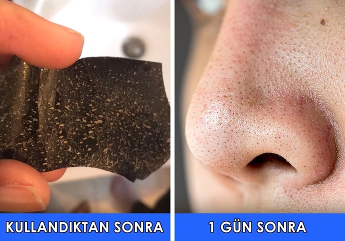 Siyah Nokta Temizleme Bandı