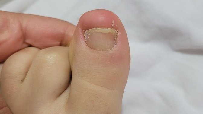 Tedavisi nedir?