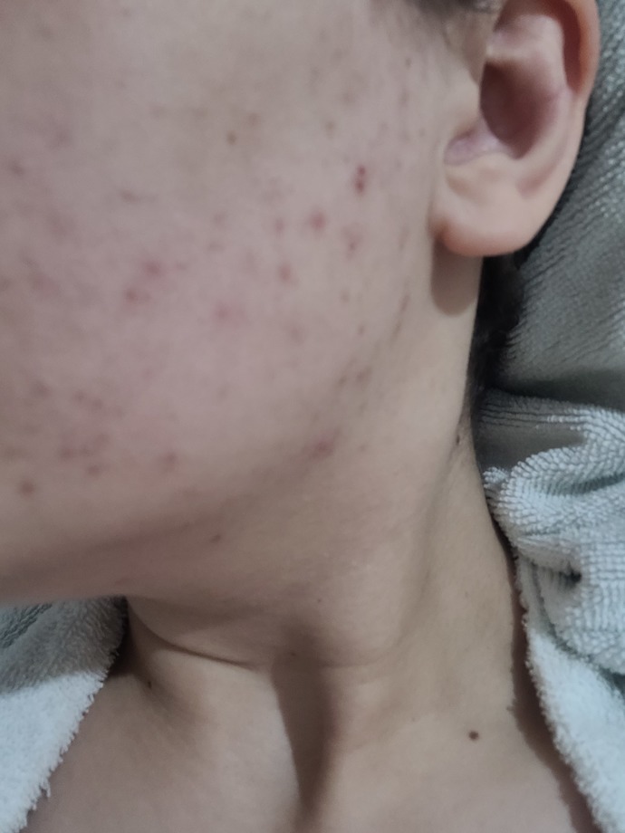 Vucudumda bu artan sivilcelenmeler niye sizce (Resimli)?