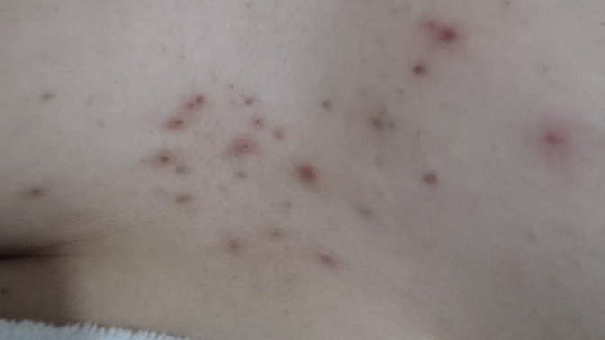 Vucudumda bu artan sivilcelenmeler niye sizce (Resimli)?