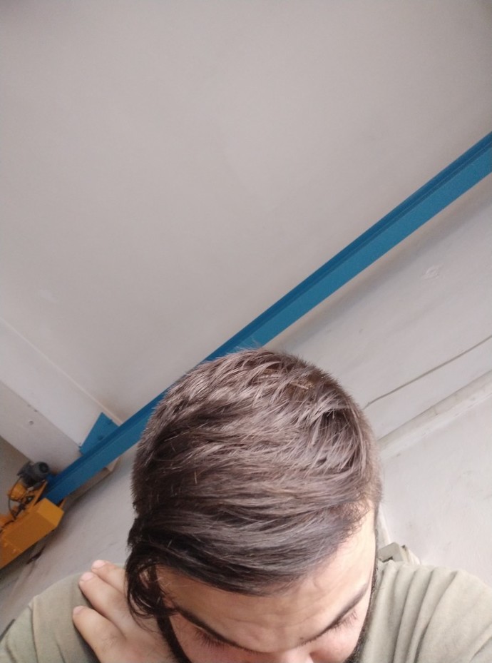 Sizce saçlarımı ektirdim çok mu kötü olmuş?
