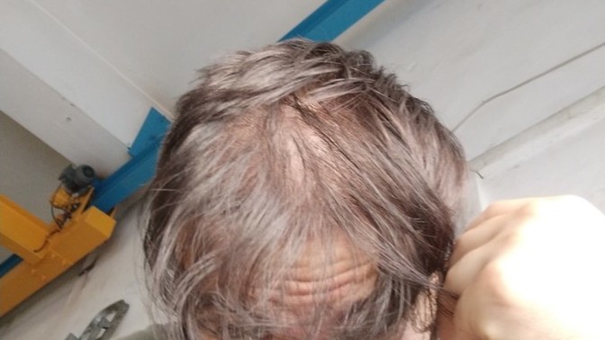 Sizce saçlarımı ektirdim çok mu kötü olmuş?