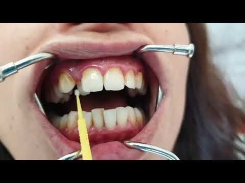 Diste metal dış teli fiyatı?