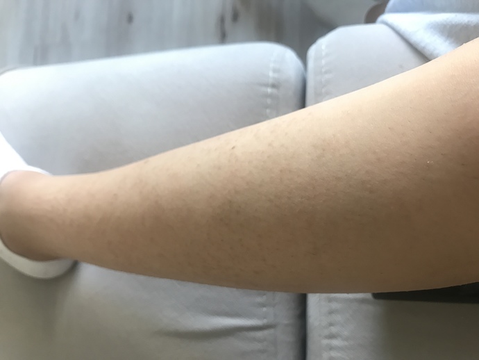 Bacaklarımdaki batıklardan dolayı etek falan giyemiyorum. Ne yapmam gerek?