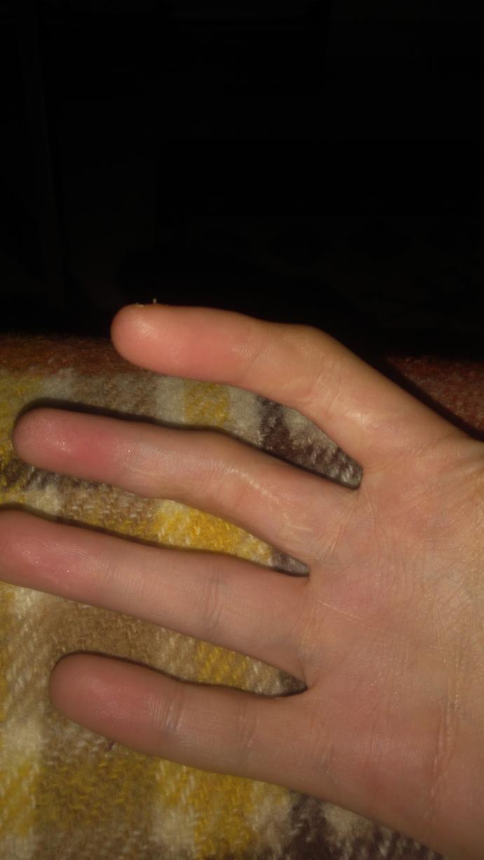 Orta parmağım çok mu yamuk? Resimli?