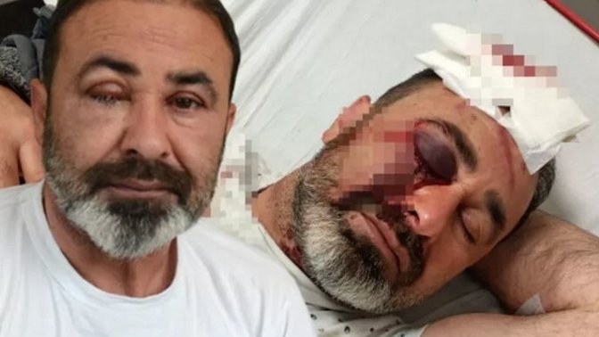 Kavgayı ayırmak isterken gözünden oldu! Kavga edenleri gördüğünüzde ayırıyor musunuz?