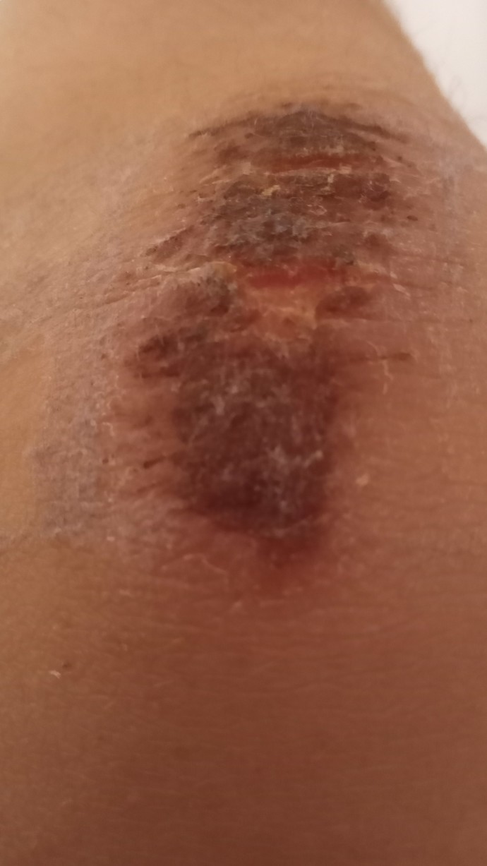 Bu yara için hastaneye gitmem gerekir mi kötü oldu baya?