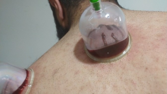 Hiç Hacamat Oldunuz Mu?