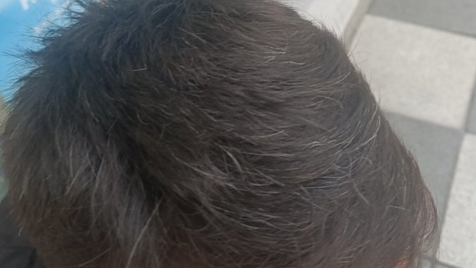 26 yaş için bu kadar beyaz saç çok mu?