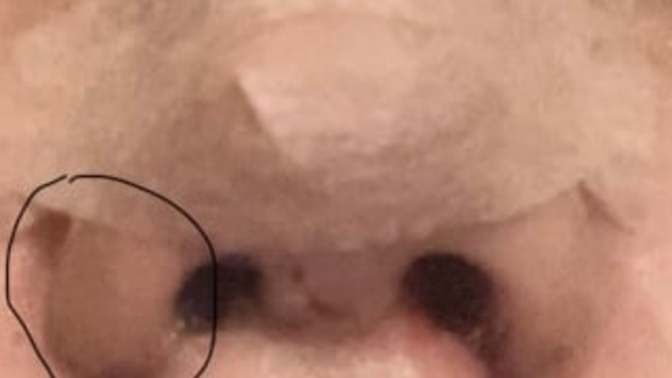 Kızlar, Burun estetiği oldummmm? Resimli?