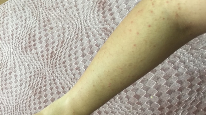 Ağda yaptıktan sonra kolumda sivilce çıkıyor, ne yapmalıyım?