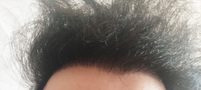 Saç ekimi yaptırdım ama ışıkta on tarafımın deri kısmı çok azcık gözüküyor. Normal mi?