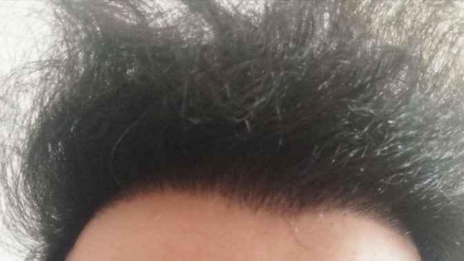 Saç ekimi yaptırdım ama ışıkta on tarafımın deri kısmı çok azcık gözüküyor. Normal mi?
