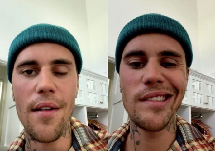 Justin Bieber yüz felci oldu! Adama nazar mı değdi?