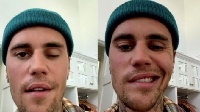 Justin Bieber yüz felci oldu! Adama nazar mı değdi?